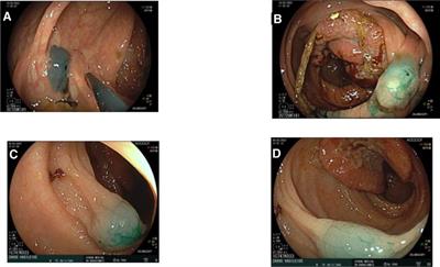Preoperative tumor marking with indocyanine green prior of robotic colorectal resections